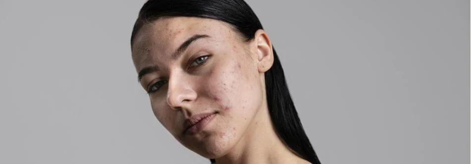 Acne Scar Reduction Treatment in Wagholi Pune